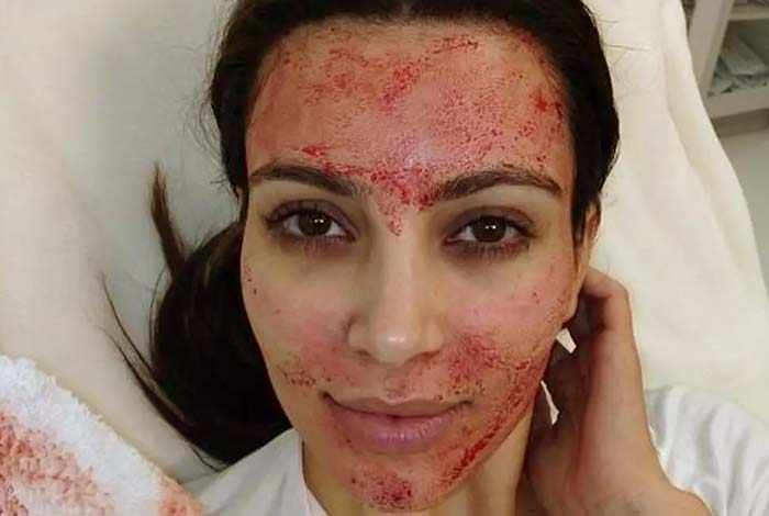 the vampire facial
